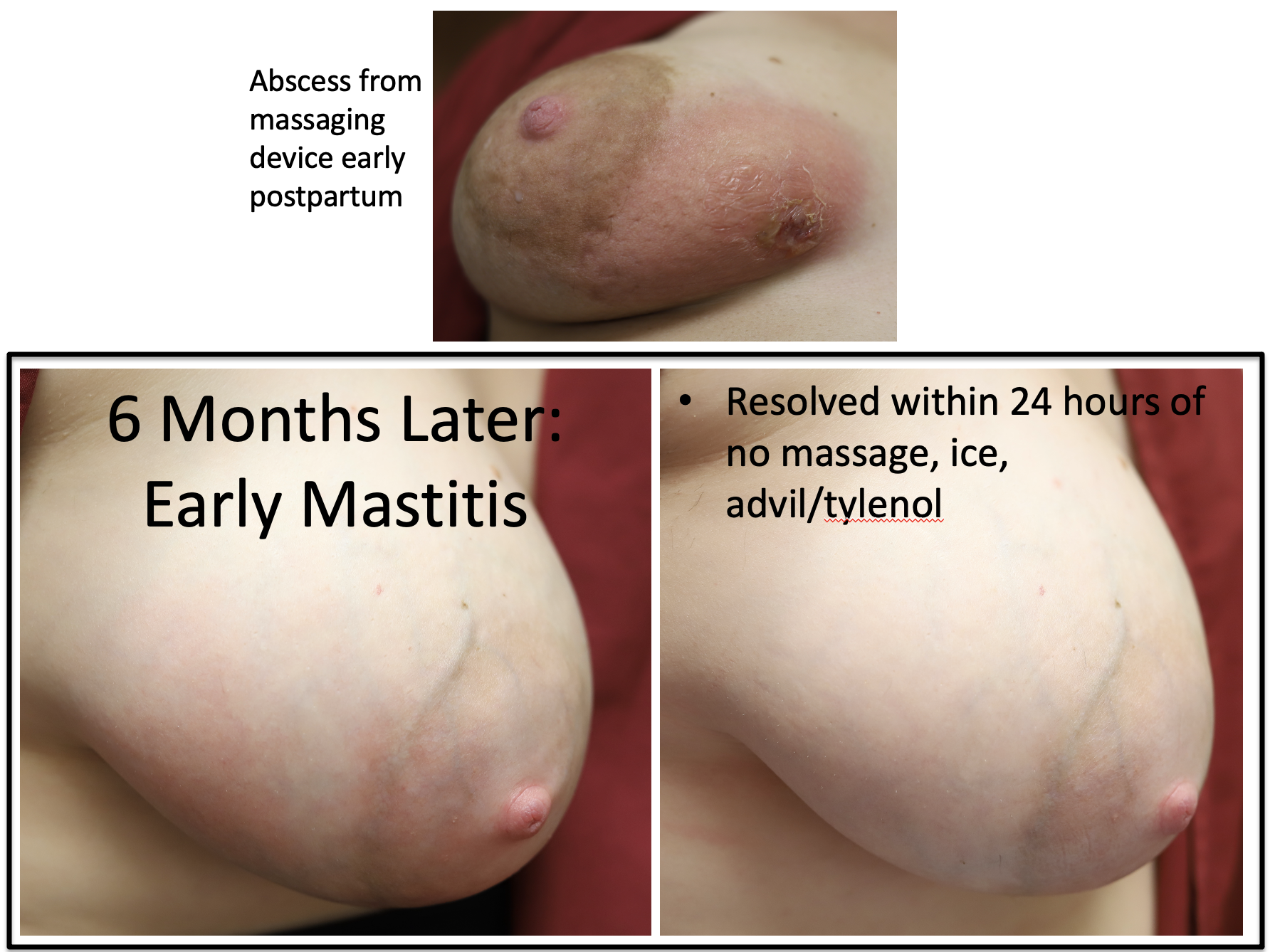 mastitis treatment